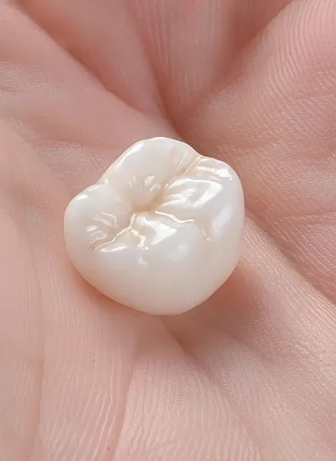 Dental Crowns at Elwell Family Dentistry in Canton, Georgia